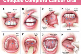 04-cancer bucal