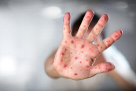 Viral Diseases - Hand Infected - Hand foot and mouth disease HFMD