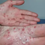 Sifilis-que-es-tratamiento-causa-sintomas