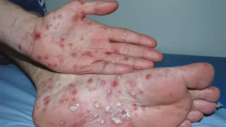 Sifilis-que-es-tratamiento-causa-sintomas