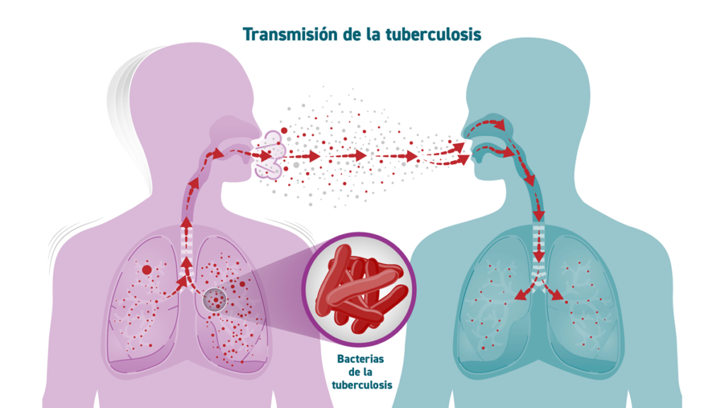 tuberculosis