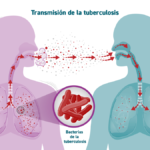 tuberculosis