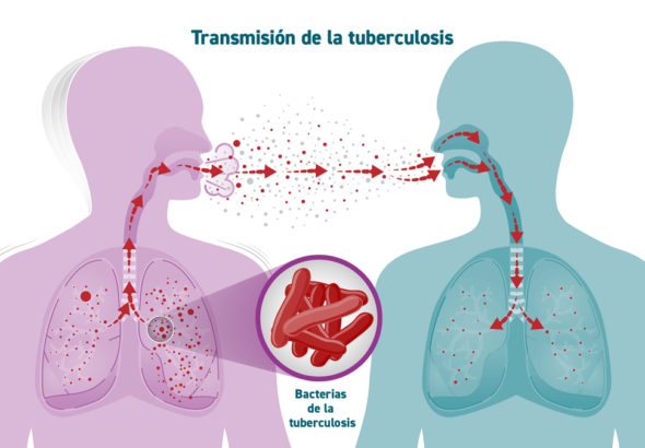 tuberculosis